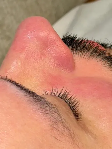Pele depois de um cuidado facial autorizado