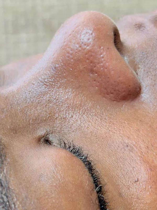 Pele depois de um cuidado facial autorizado