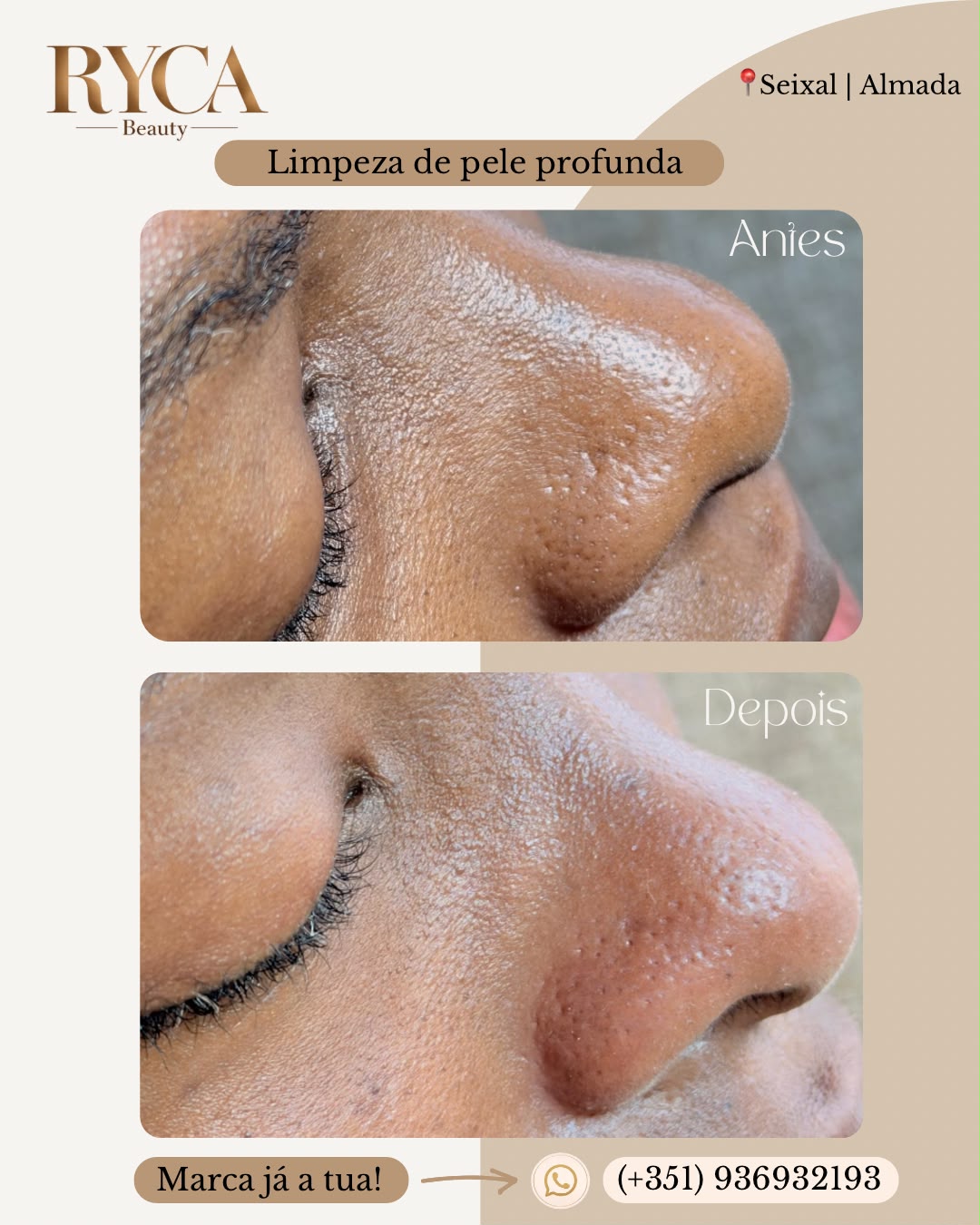Antes e depois de tratamento facial Ryca Beauty - caso 1
