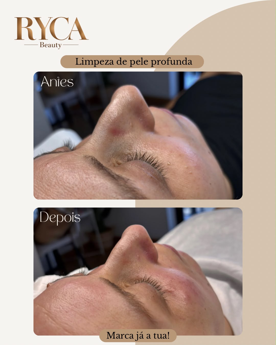 Antes e depois de tratamento facial Ryca Beauty - caso 2