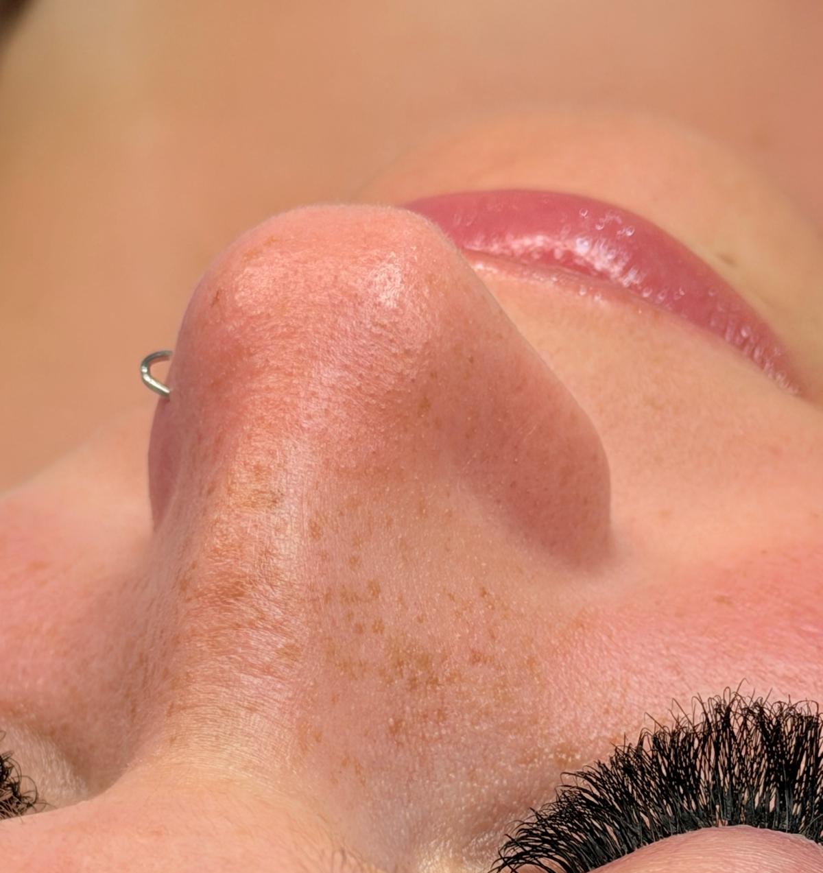 Pele antes da limpeza de pele profunda Ryca Beauty